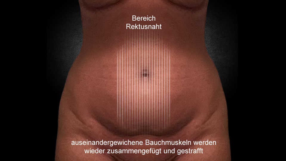 04-1-bereich-rektusnaht