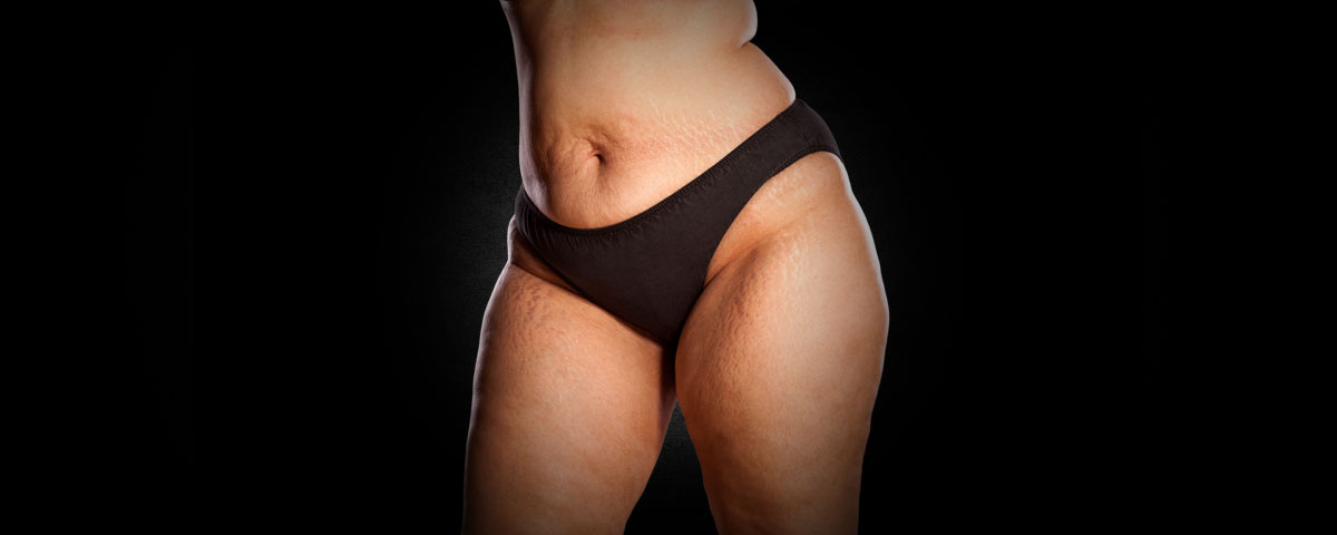 Liposuktion Lipoedem