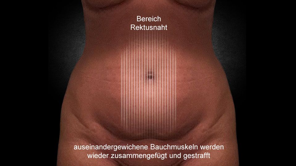 04-1-bereich-rektusnaht